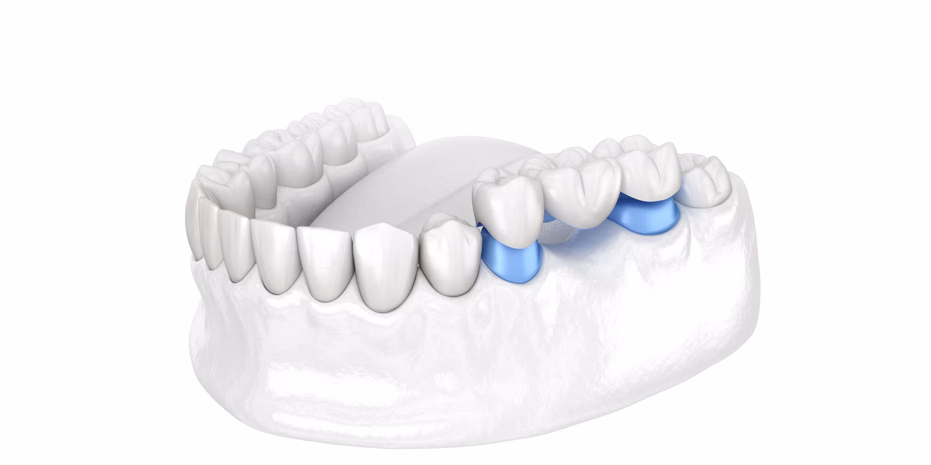 Custom-fitted sports mouthguard made at a Queenstown dental practice
