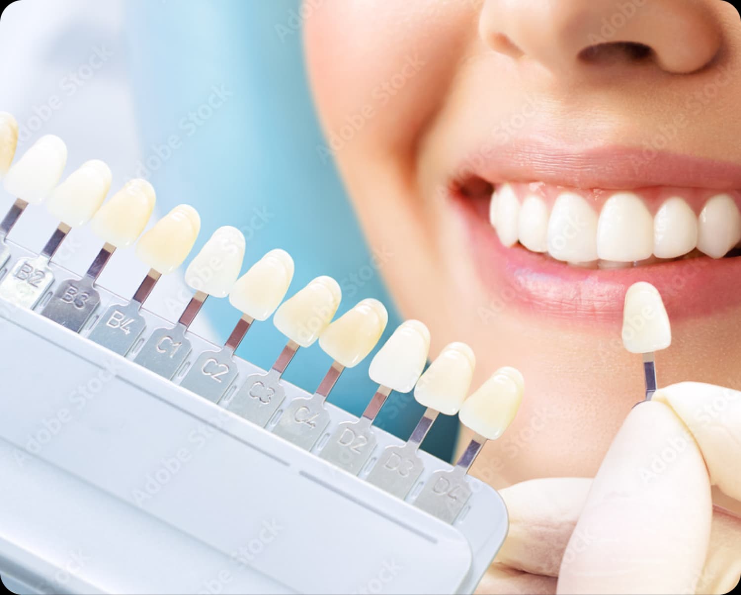 Shade matching during digital smile design