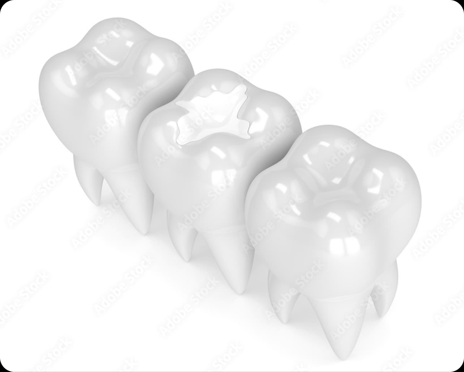 Close-up of restored tooth enamel